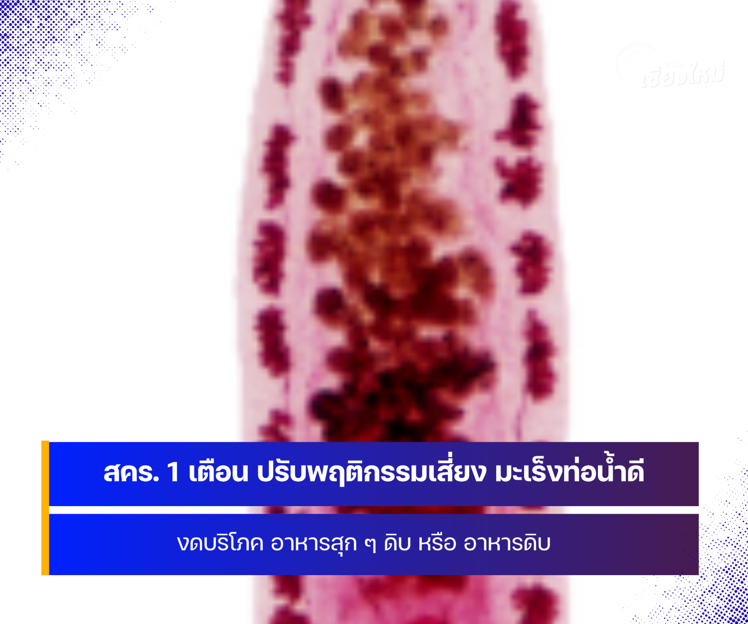 สคร. 1 เชียงใหม่ เตือน ประชาชน ปรับพฤติกรรม ลดความเสี่ยง มะเร็งท่อน้ำดี