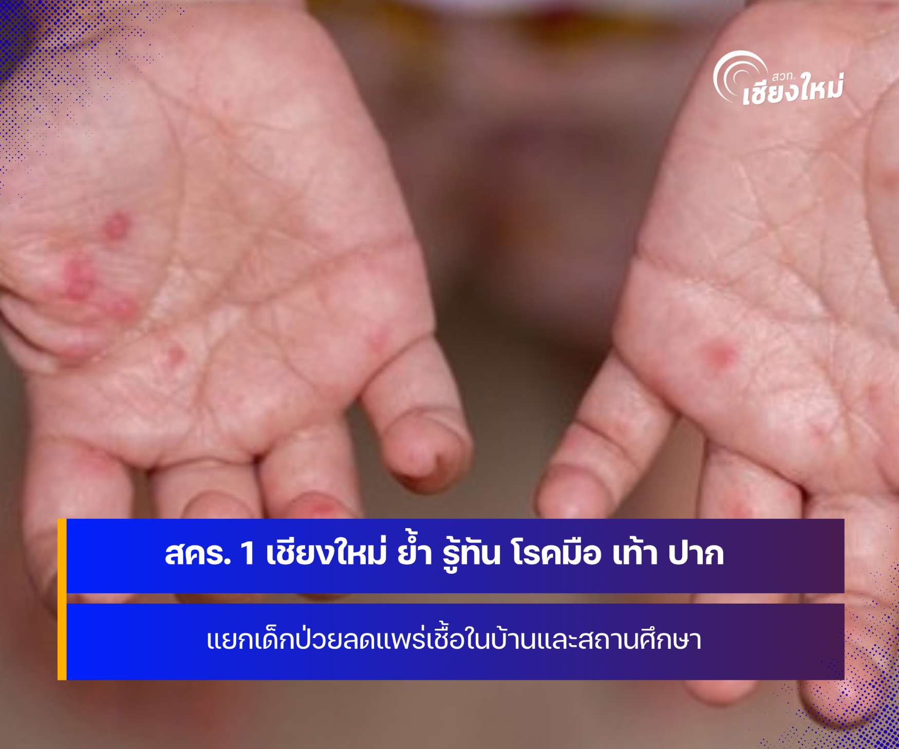 สคร. 1 ย้ำ รู้ทัน โรคมือ เท้า ปาก แยกเด็กป่วยลดแพร่เชื้อในบ้านและสถานศึกษา
